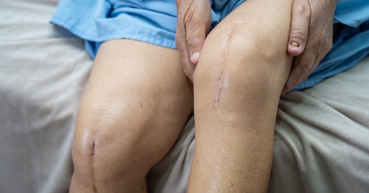 asian-senior-woman-patient-show-her-scars-surgical-total-knee-joint-replacement-suture-wound-surgery