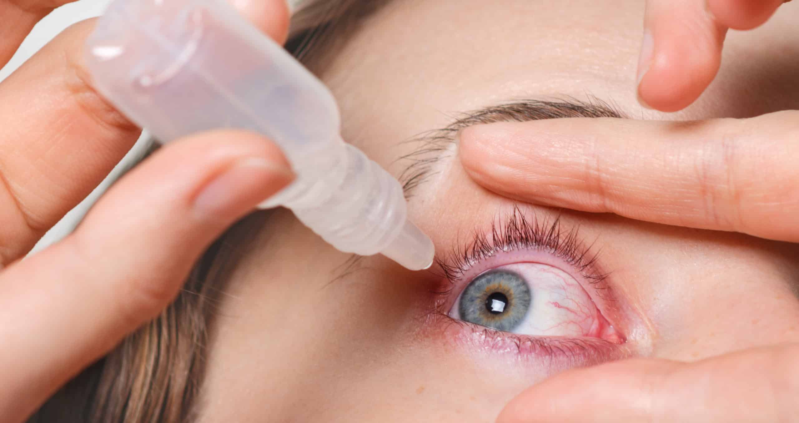 close-up-female-pours-drops-red-eye-has-conjuctivitis-glaucoma-bad-eyesight-pain-eyes-pain-treatment-concept-woman-cures-red-blood-eye-scaled