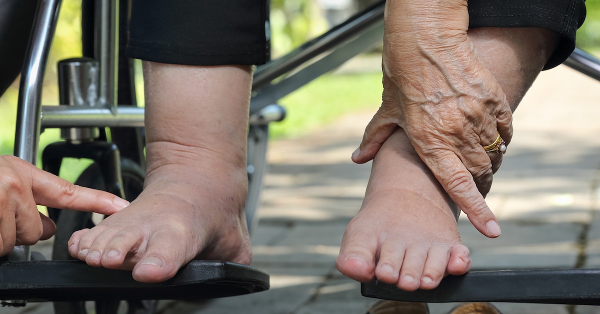 elderly-woman-swollen-feet-press-test-wheelchair