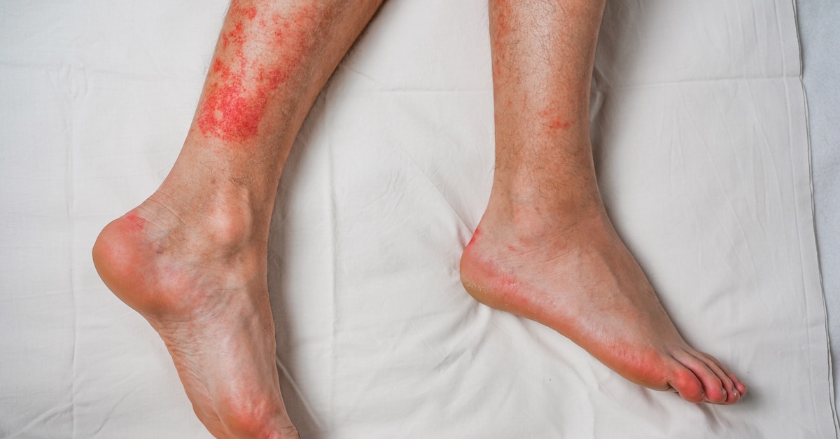 male-leg-itching-red-rash-caused-by-insect-bites-bites-health-medical-surveillance-concept-development