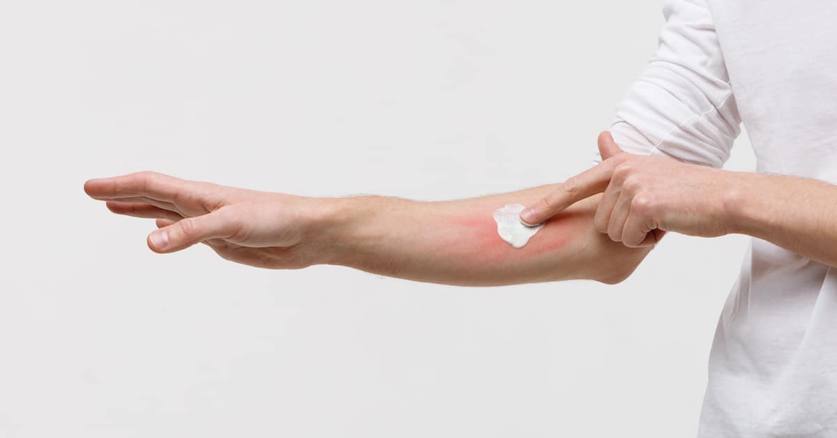 man-applying-cream-swell-skin-against-mosquito-bites
