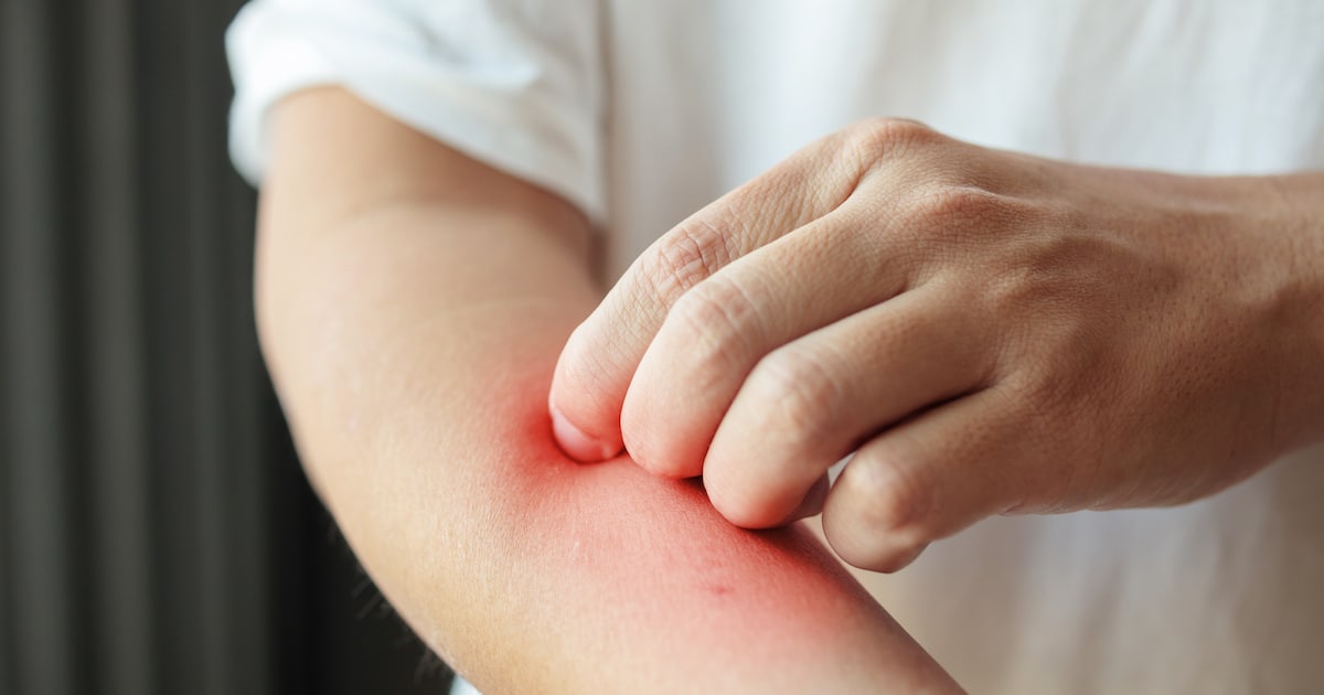 man-itching-scratching-arm-from-insect-bite-itchy-dry-skin-eczema-dermatitis