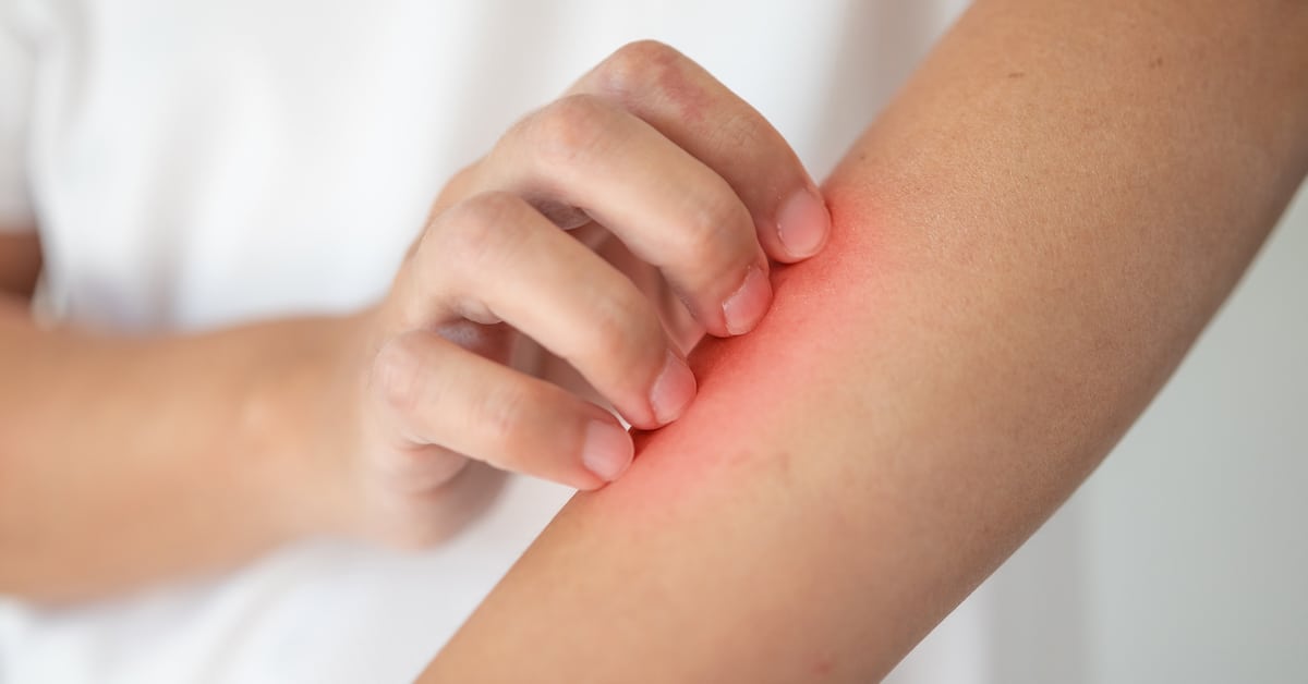 man-itching-scratching-arm-from-itchy-dry-skin-eczema-dermatitis