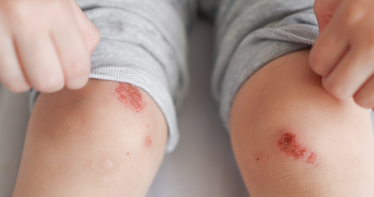 wounds-knees-child-damaged-skin-legs-falling-injury-first-aid